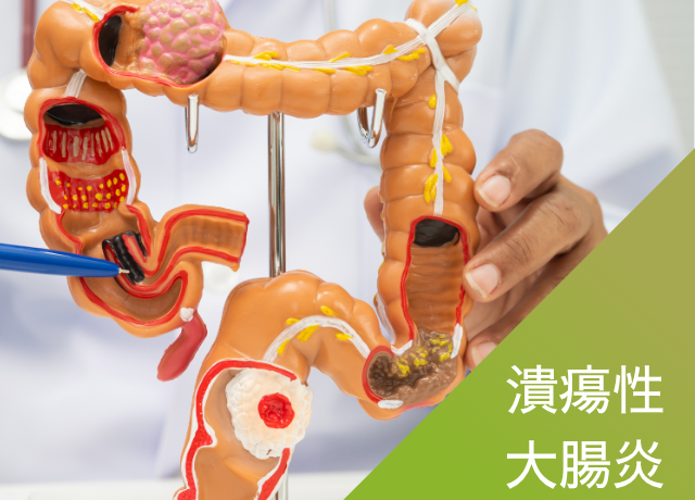 潰瘍性大腸炎